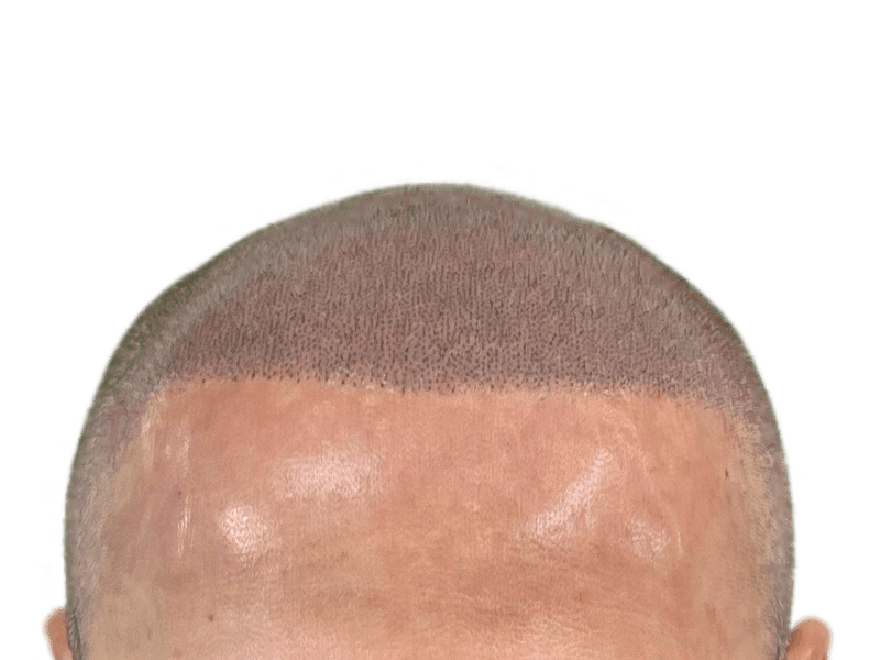 Hair transplant result: Dense, natural hairline achieved. Caucasian male. Hair restoration success. Before/After potential.