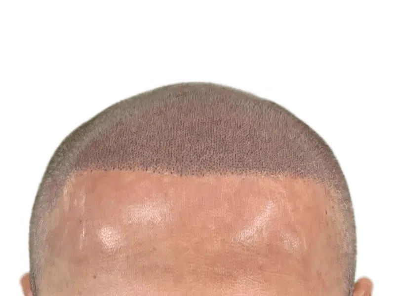 Hair transplant result: Dense, natural hairline achieved. Caucasian male. Hair restoration success. Before/After potential.