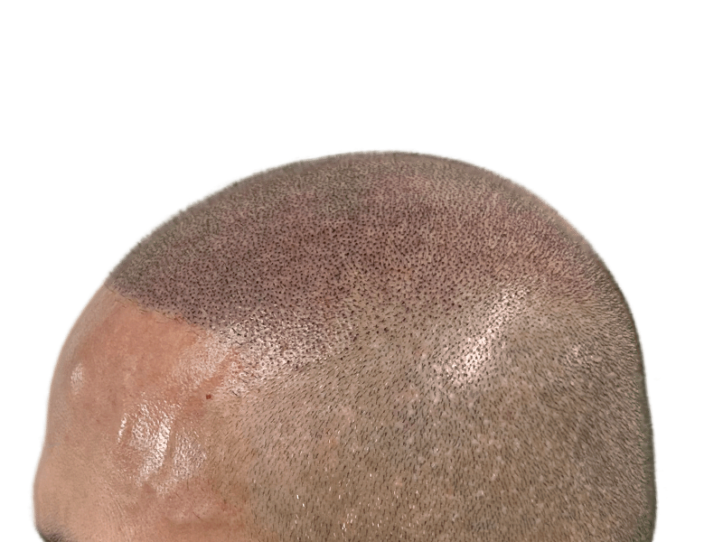 Hair transplant result: Close-up of implanted follicles on fair skin. High density, natural hairline. Hair restoration success.