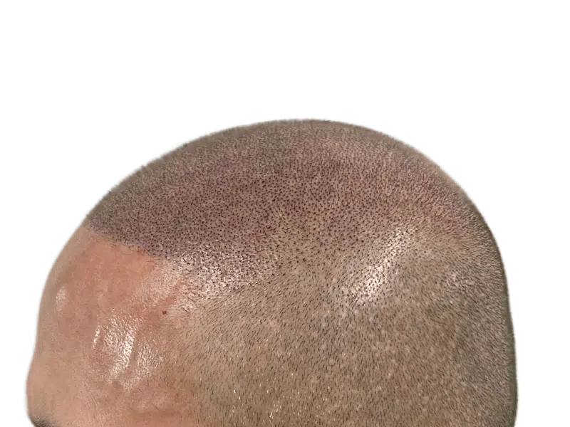 Hair transplant result: Close-up of implanted follicles on fair skin. High density, natural hairline. Hair restoration success.