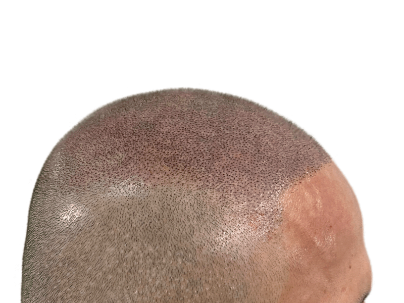 Hair transplant close-up: Caucasian male. Noticeable hair density difference showcasing hair restoration results.