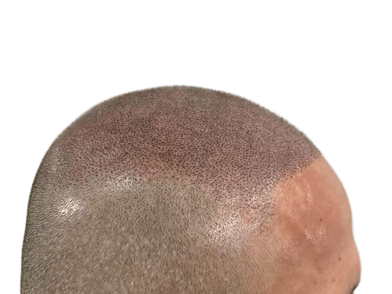 Hair transplant close-up: Caucasian male. Noticeable hair density difference showcasing hair restoration results.