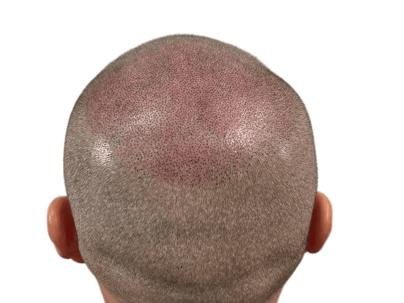 Hair transplant result: Increased density on back of head. Graying hair, showing follicle placement. Hair restoration success.