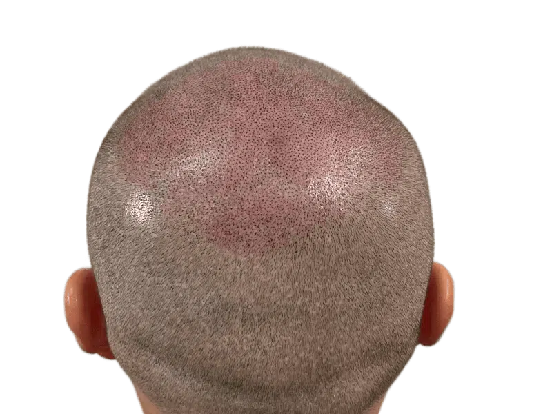 Hair transplant result: Increased density on back of head. Graying hair, showing follicle placement. Hair restoration success.