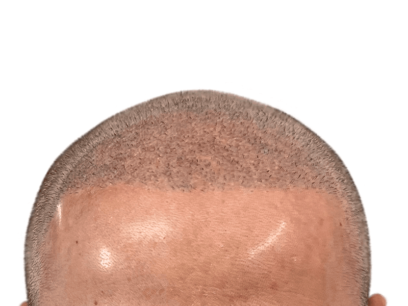 Hair transplant result: Dense, natural hairline restoration. Close-up shows new follicle growth. Before/after potential.