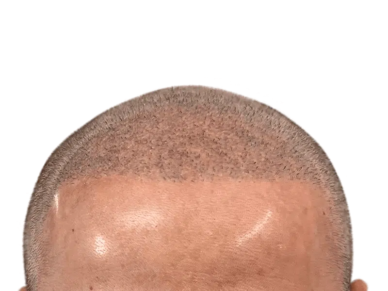 Hair transplant result: Dense, natural hairline restoration. Close-up shows new follicle growth. Before/after potential.