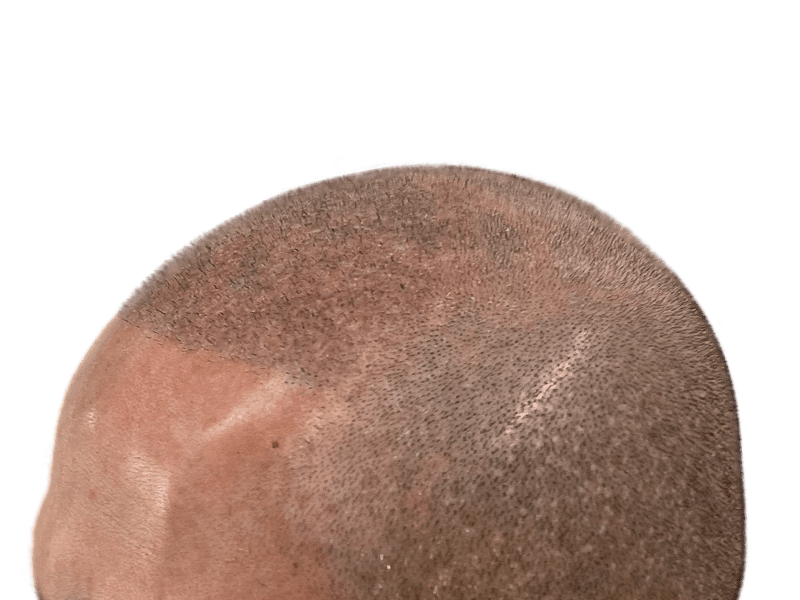 Scalp close-up showing hair transplant scar. Possible before/after hair restoration result. Shaved head, light skin tone.
