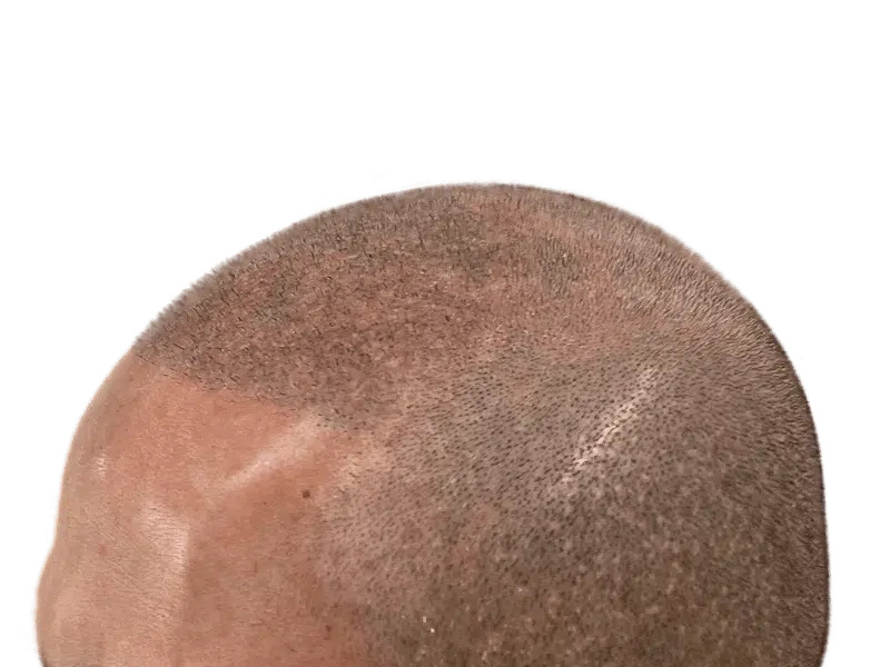 Scalp close-up showing hair transplant scar. Possible before/after hair restoration result. Shaved head, light skin tone.