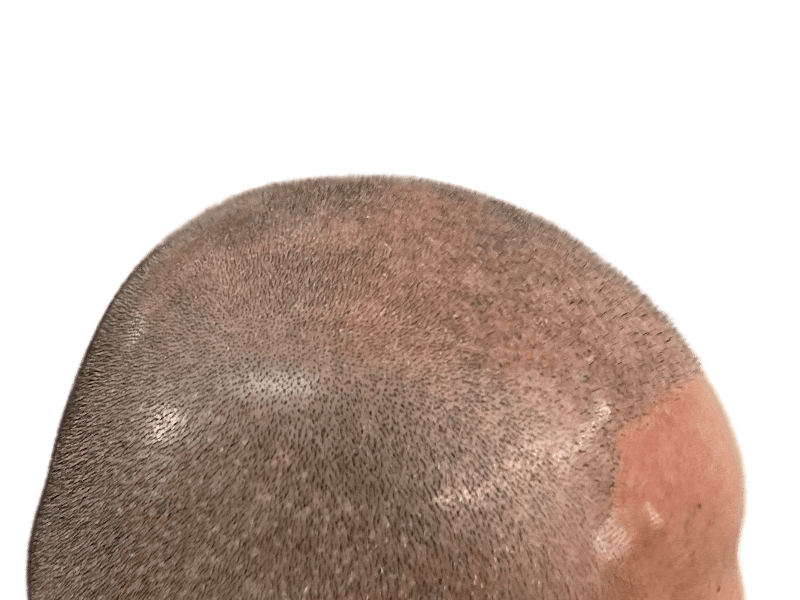 Thinning hair on scalp. Possible hair loss or balding. Could be before hair restoration or transplant procedure.