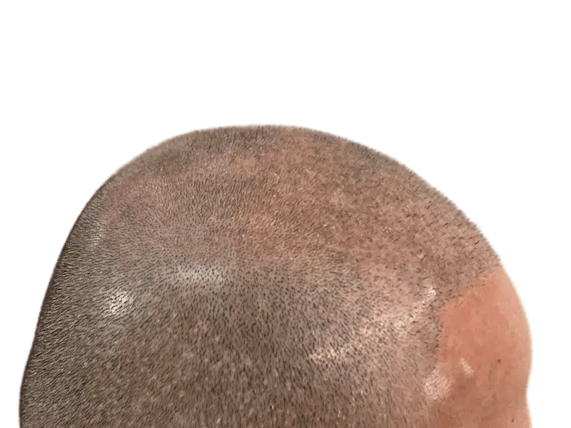 Thinning hair on scalp. Possible hair loss or balding. Could be before hair restoration or transplant procedure.