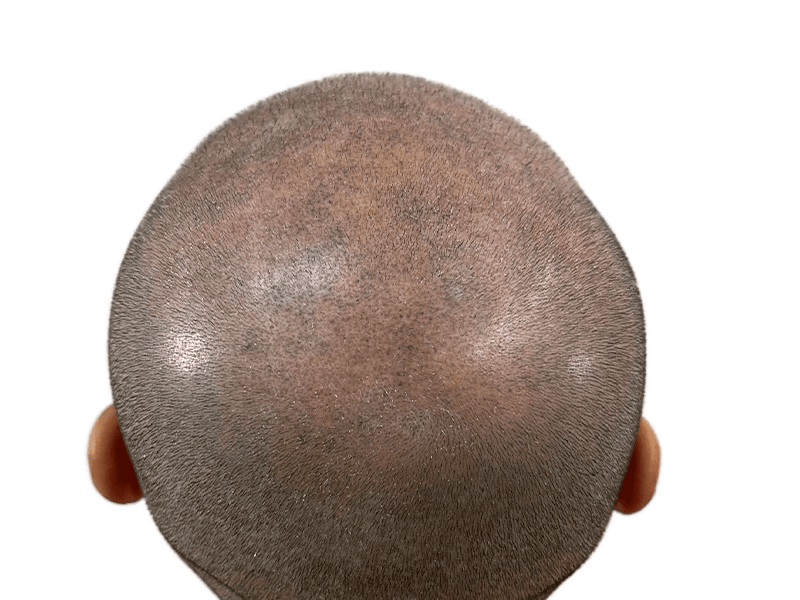 Close-up of scalp. Uniformly short hair, possibly pre-hair transplant. No before/after comparison available.