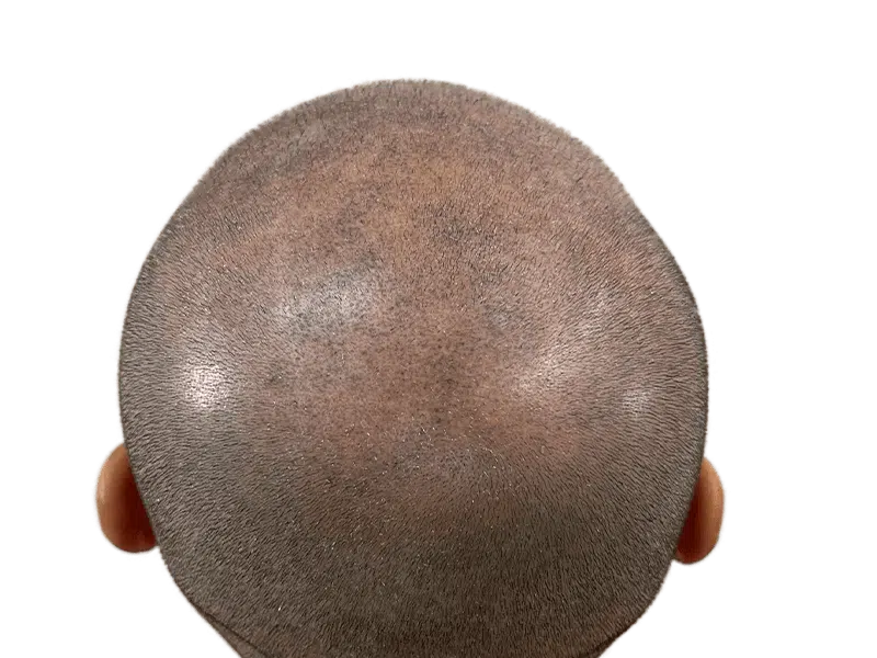 Close-up of scalp. Uniformly short hair, possibly pre-hair transplant. No before/after comparison available.