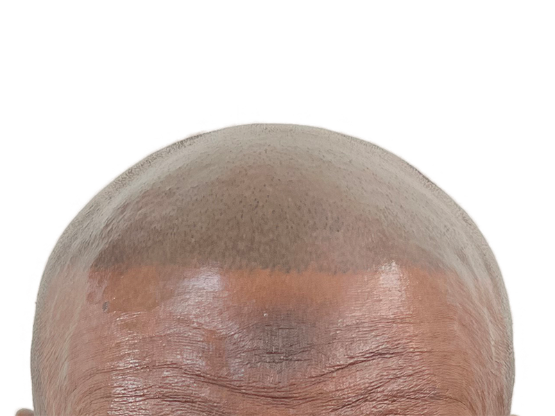 Bald African American man's head. Hair transplant before. Hair restoration results. Dark skin, shiny scalp.