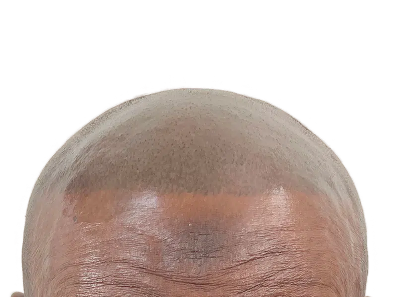 Bald African American man's head. Hair transplant before. Hair restoration results. Dark skin, shiny scalp.