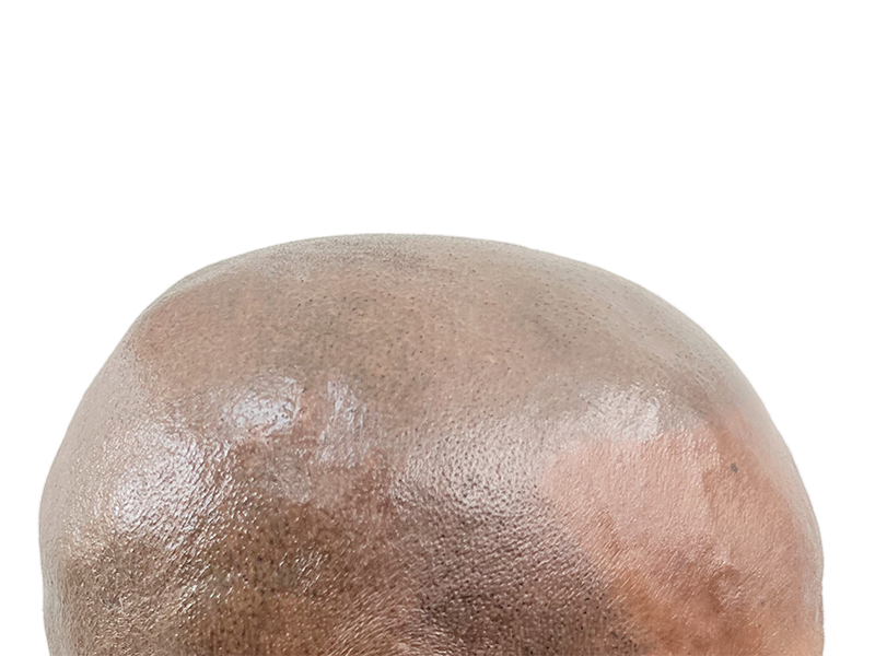Before hair transplant: Bald head showing smooth scalp. Hair restoration procedure preparation. Dark skin tone.
