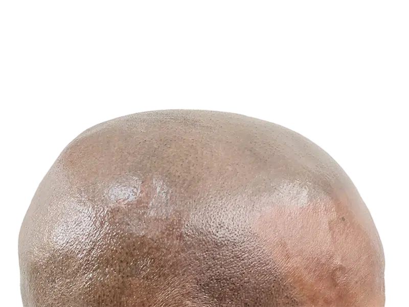 Before hair transplant: Bald head showing smooth scalp. Hair restoration procedure preparation. Dark skin tone.
