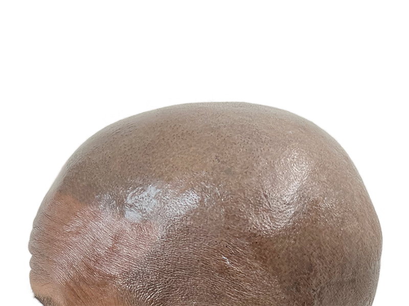 Bald head close-up. Hair restoration candidate? Potential hair transplant before photo. Scalp detail.