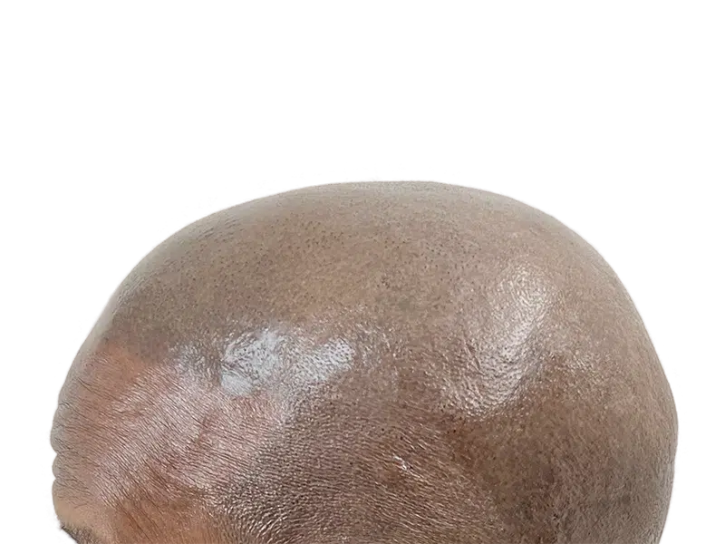 Bald head close-up. Hair restoration candidate? Potential hair transplant before photo. Scalp detail.