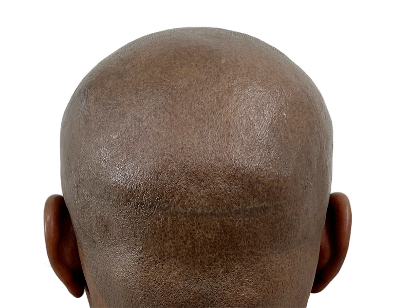Hair transplant scar on scalp of Black man. Hair restoration result. Before/after potential. Baldness treatment.