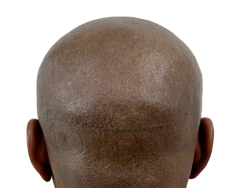 Hair transplant scar on scalp of Black man. Hair restoration result. Before/after potential. Baldness treatment.