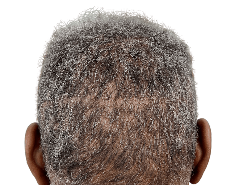 Hair transplant result: Thicker hair on crown, visible scar. Before/after hair restoration for thinning hair.