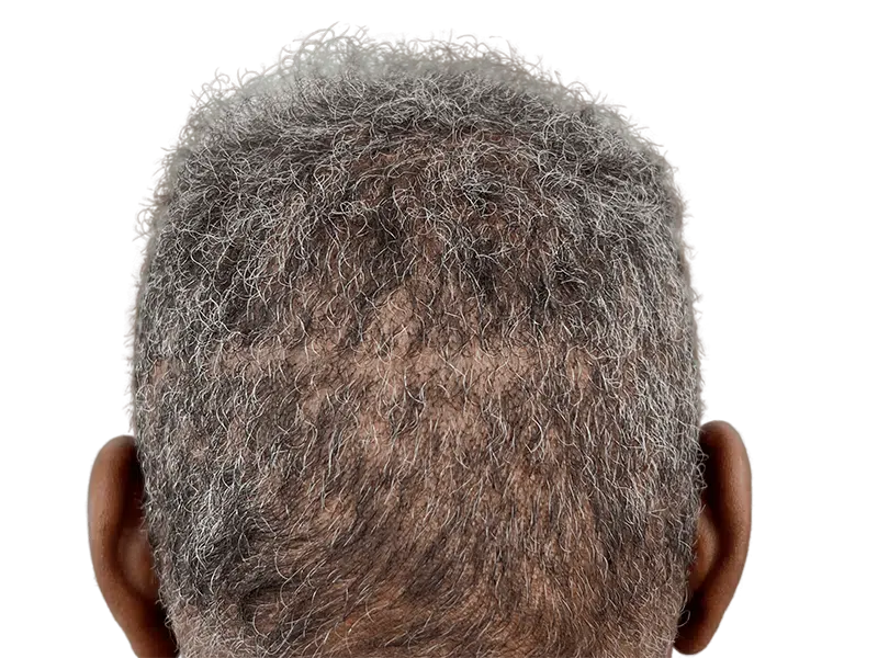 Hair transplant result: Thicker hair on crown, visible scar. Before/after hair restoration for thinning hair.
