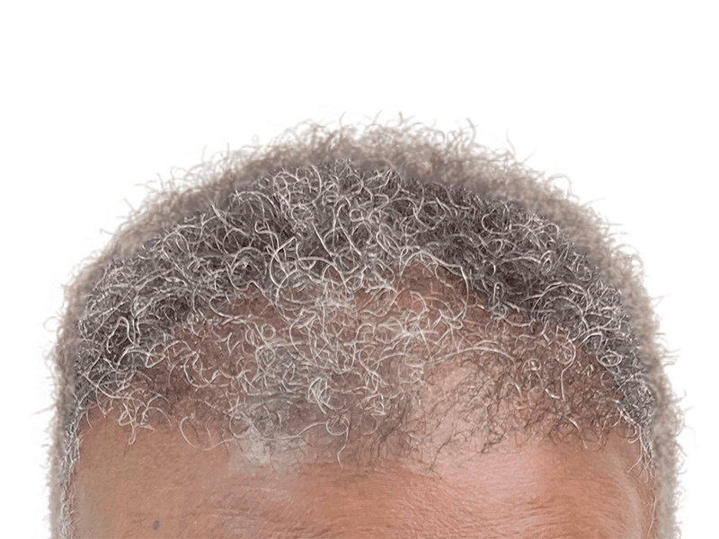 Gray curly hair, receding hairline. Could be a candidate for hair restoration. No visible transplant scars.