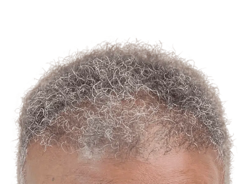 Gray curly hair, receding hairline. Could be a candidate for hair restoration. No visible transplant scars.