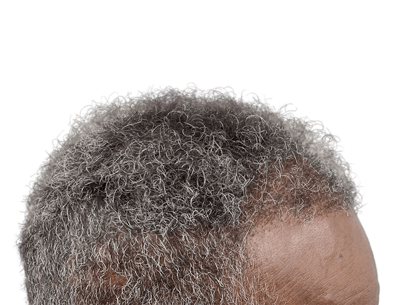 Receding hairline on African American man. Hair restoration options available. Before treatment example.
