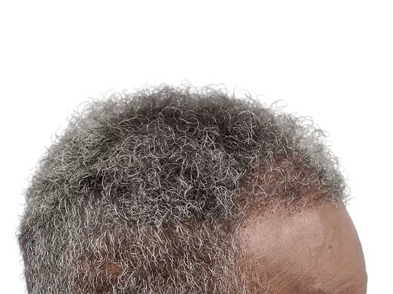 Receding hairline on African American man. Hair restoration options available. Before treatment example.