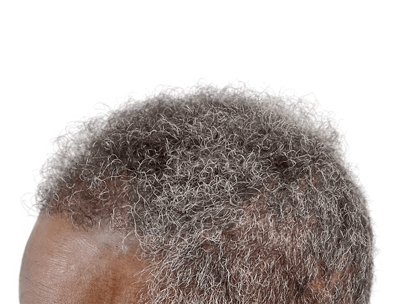Graying, curly hair on a man's head. Receding hairline visible. Potential hair restoration candidate. No transplant shown.