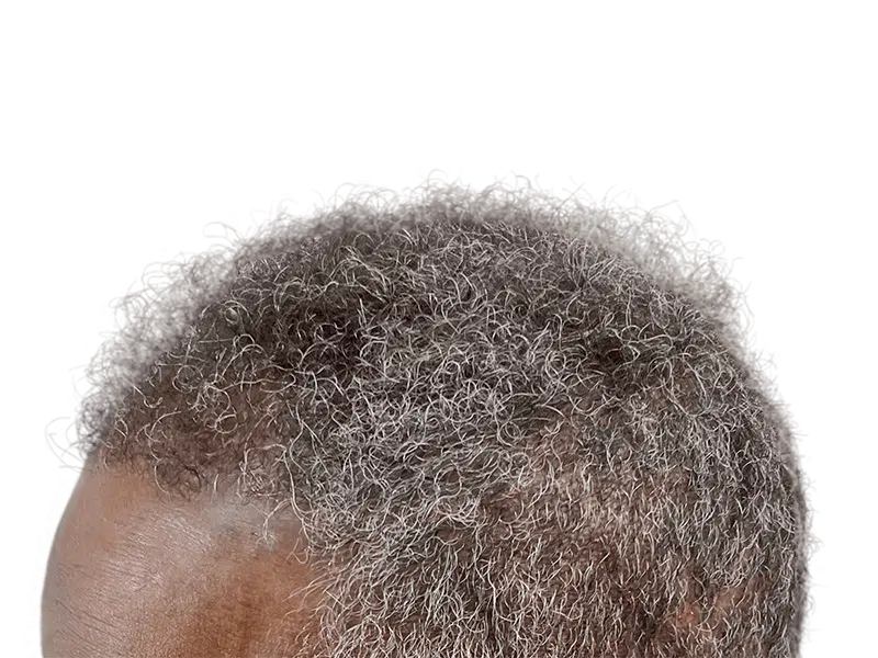 Graying, curly hair on a man's head. Receding hairline visible. Potential hair restoration candidate. No transplant shown.