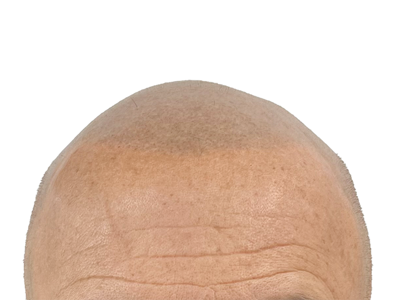 Balding Caucasian man's forehead. Hair loss visible. Potential candidate for hair restoration or transplant. Before treatment.
