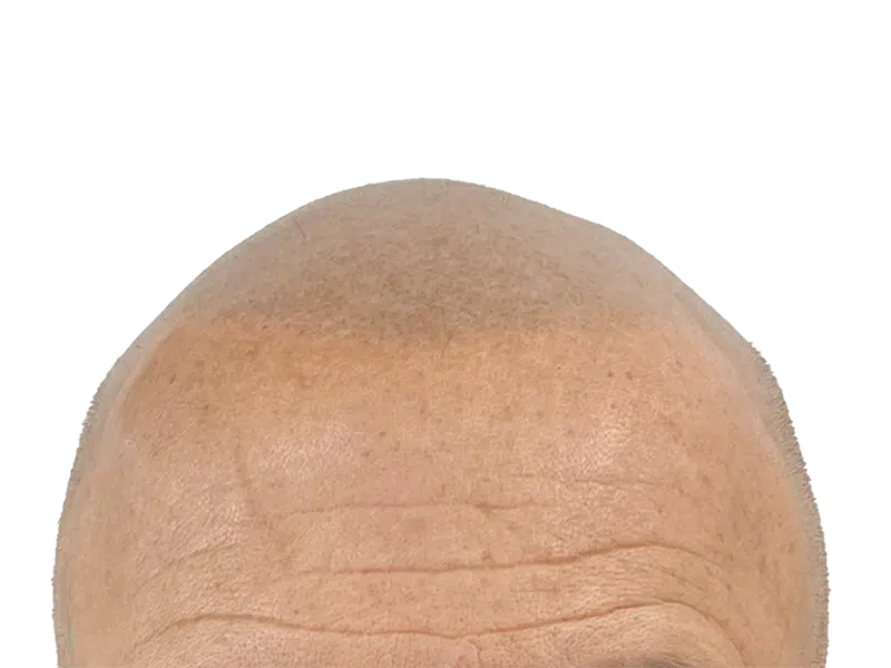 Balding Caucasian man's forehead. Hair loss visible. Potential candidate for hair restoration or transplant. Before treatment.