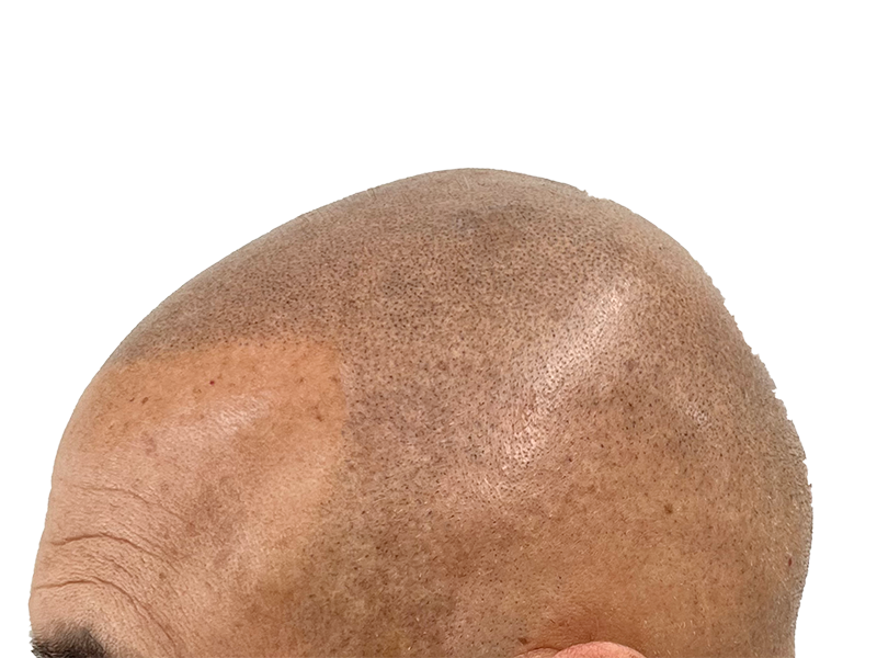 Hair transplant close-up: Bald scalp showing transplanted follicles. Hair restoration procedure result. Before hair growth.