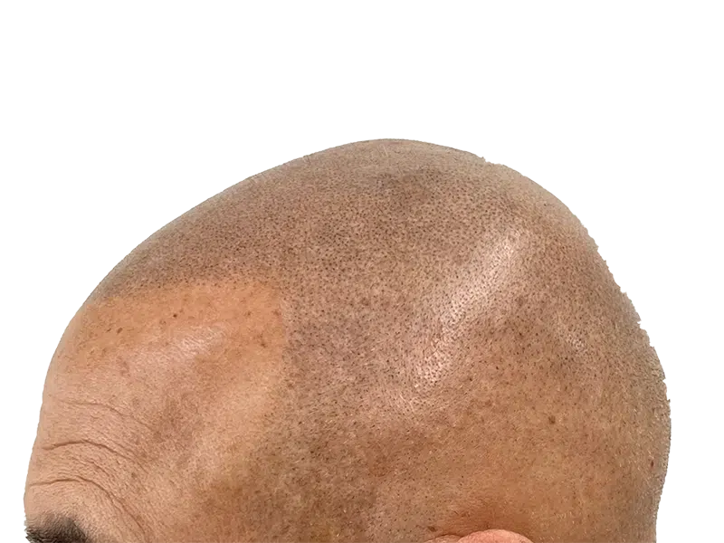 Hair transplant close-up: Bald scalp showing transplanted follicles. Hair restoration procedure result. Before hair growth.