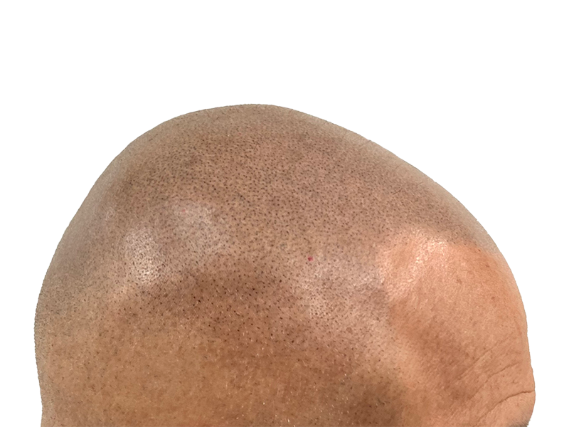 Hair transplant result: Shaved head showing dense, natural hair growth. Before & after hair restoration success.