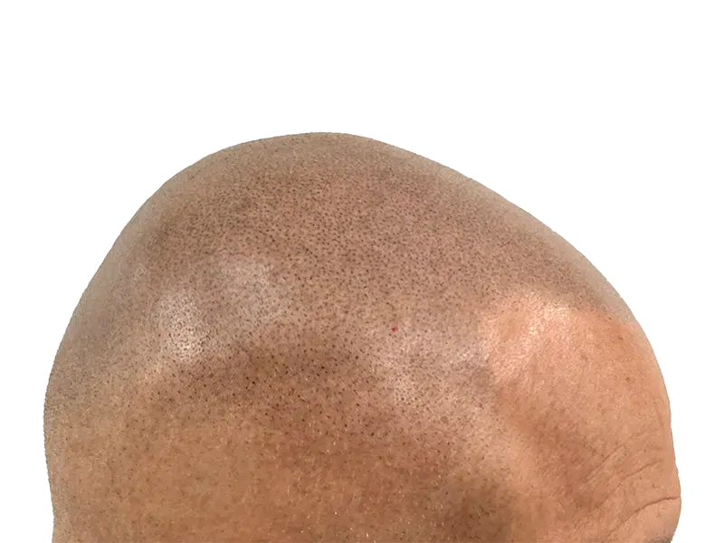 Hair transplant result: Shaved head showing dense, natural hair growth. Before & after hair restoration success.