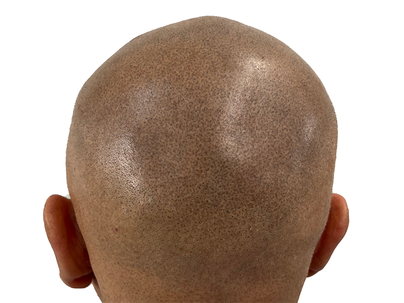 Hair transplant result: Shaved head showing dense follicle placement. Hair restoration procedure for fuller hair.