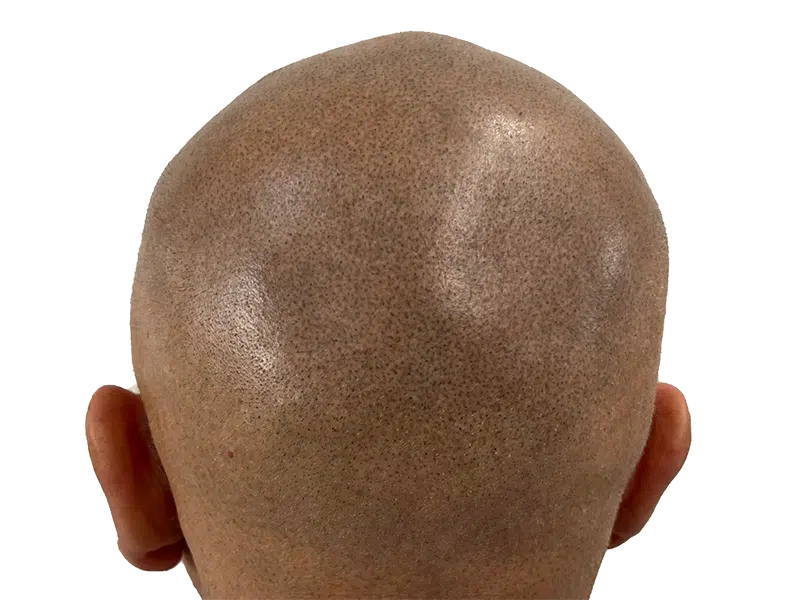 Hair transplant result: Shaved head showing dense follicle placement. Hair restoration procedure for fuller hair.