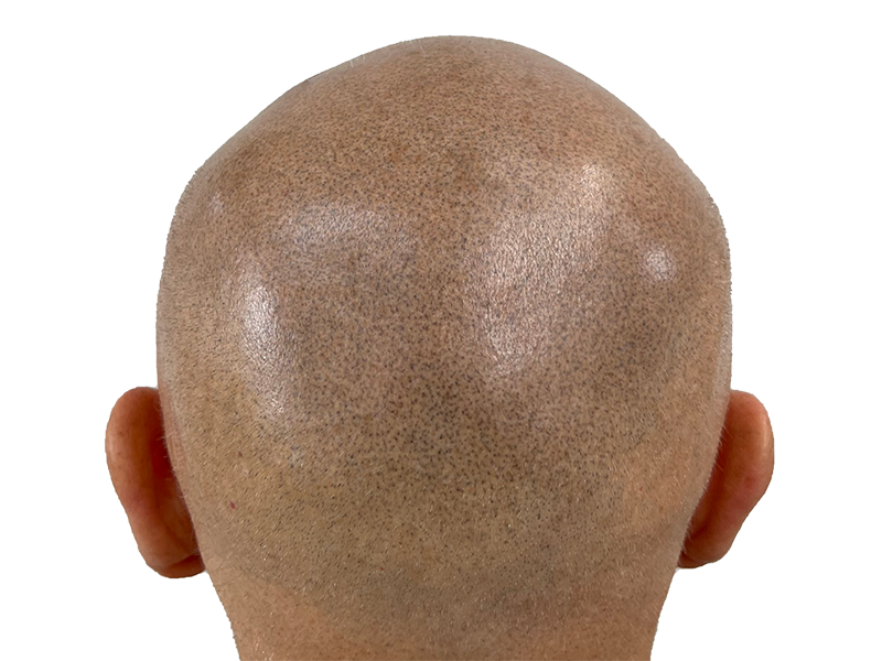 Hair transplant result: Back of head shows fuller coverage after hair restoration. Before/after visible.