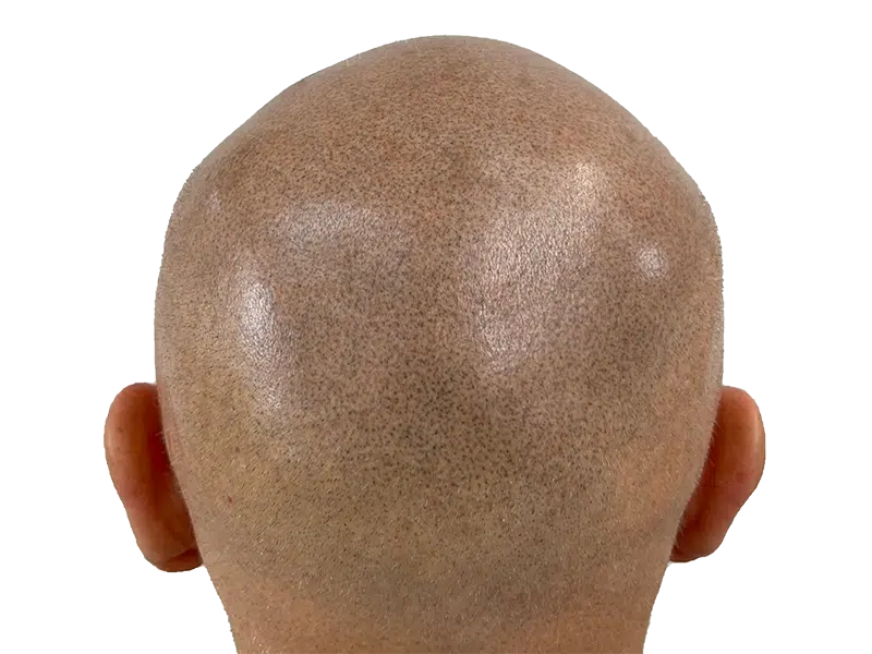 Hair transplant result: Back of head shows fuller coverage after hair restoration. Before/after visible.