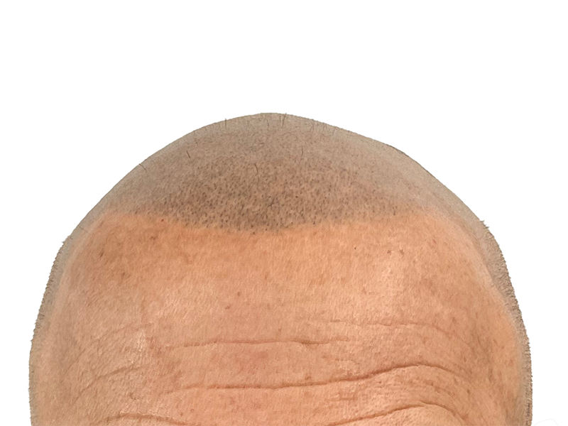 Hair restoration result: Improved hairline after transplant. New hair growth visible. Before/after transformation.