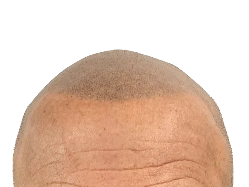 Hair restoration result: Improved hairline after transplant. New hair growth visible. Before/after transformation.