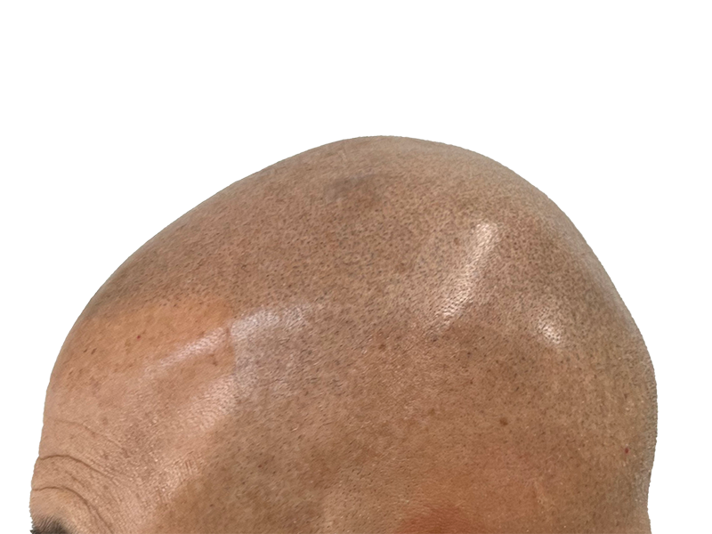 Hair transplant: Close-up of scalp after hair restoration procedure. Bald head showing follicle implantation. Hair restoration results.