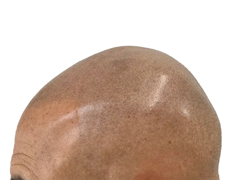 Hair transplant: Close-up of scalp after hair restoration procedure. Bald head showing follicle implantation. Hair restoration results.