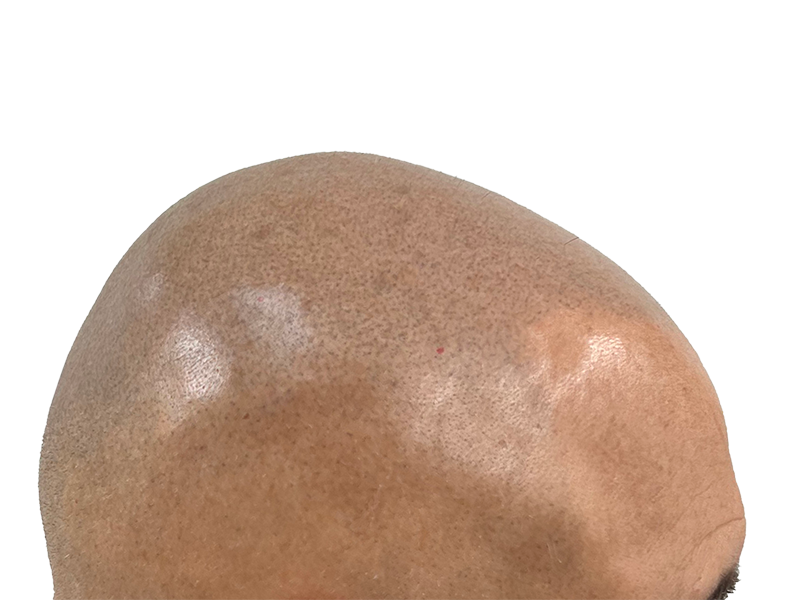 Bald scalp. Hair loss treatment or hair transplant consideration. Before hair restoration. Male pattern baldness.