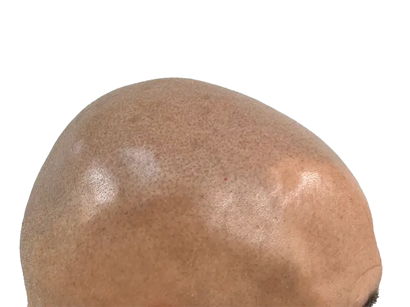 Bald scalp. Hair loss treatment or hair transplant consideration. Before hair restoration. Male pattern baldness.
