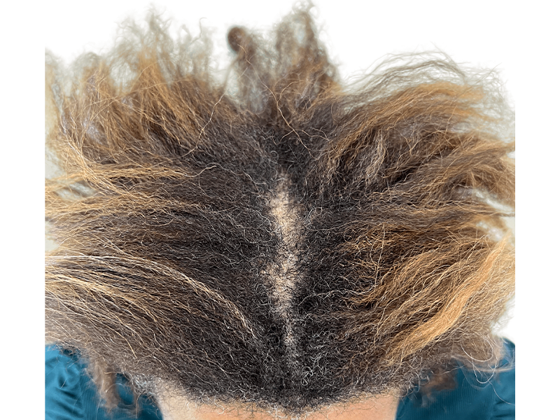 Dark brown & blonde hair, middle part. Scalp visible. Consider hair restoration options for thinning hair. Before/after potential.