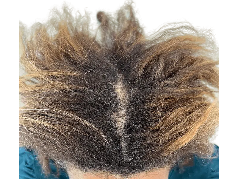 Dark brown & blonde hair, middle part. Scalp visible. Consider hair restoration options for thinning hair. Before/after potential.